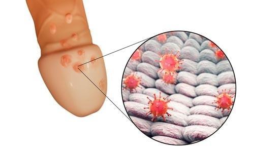 mụn rộp sinh dục nam mụn rộp sinh dục nam