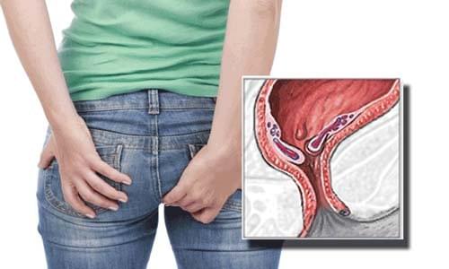 Bệnh trĩ tiềm ẩn nhiều nguy hiểm Bệnh trĩ tiềm ẩn nhiều nguy hiểm