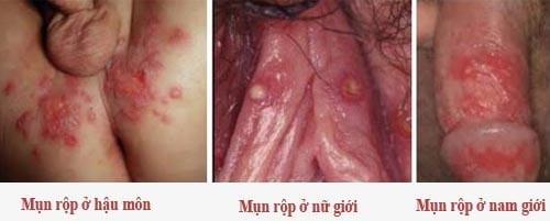 Hình ảnh mụn rộp ở nam, nữ và hậu môn Hình ảnh mụn rộp ở nam, nữ và hậu môn