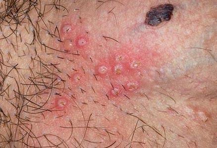 mụn rộp ở bộ phận sinh dục mụn rộp ở bộ phận sinh dục