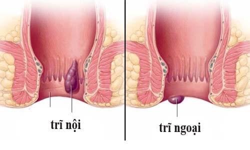 bệnh trĩ là gì bệnh trĩ là gì