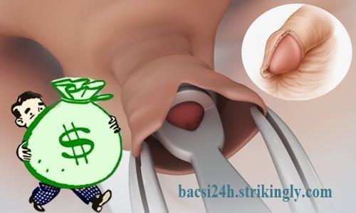 chi phí cắt bao quy đầu giá bao nhiêu tiền chi phí cắt bao quy đầu giá bao nhiêu tiền