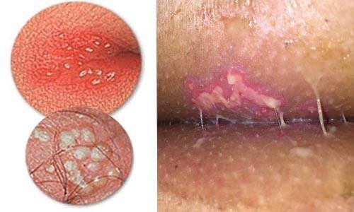 mụn rộp sinh dục là gì mụn rộp sinh dục là gì
