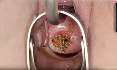 điều trị bệnh viêm cổ tử cung điều trị bệnh viêm cổ tử cung