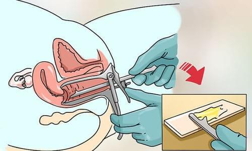 chẩn đoán bệnh viêm âm đạo chẩn đoán bệnh viêm âm đạo