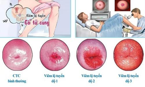 đốt viêm lộ tuyến có đau không đốt viêm lộ tuyến có đau không