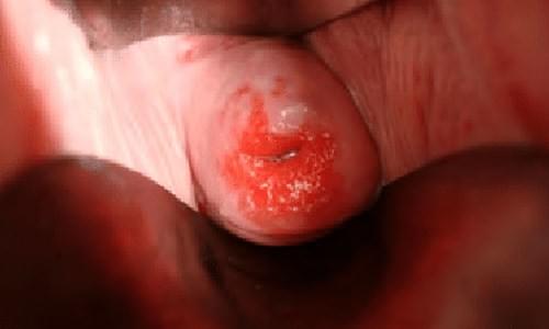 triệu chứng của bệnh viêm cổ tử cung triệu chứng của bệnh viêm cổ tử cung