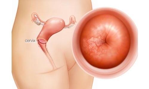 Viêm lộ tuyến cổ tử cung là gì Viêm lộ tuyến cổ tử cung là gì