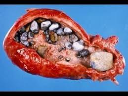 OBAT BATU GINJAL OBAT BATU GINJAL