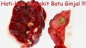 PENYAKIT BATU GINJAL PENYAKIT BATU GINJAL