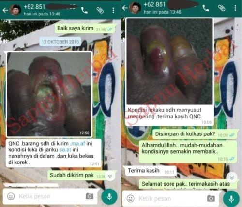 Obat Bekas Operasi Caesar Di Apotik, Salep Pengering Luka Operasi 100% Ampuh Obat Bekas Operasi Caesar Di Apotik, Salep Pengering Luka Operasi 100% Ampuh