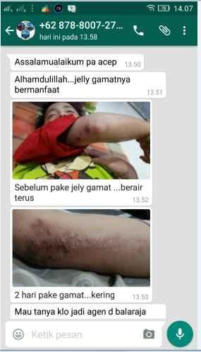 Obat Bekas Operasi Caesar Di Apotik, Salep Pengering Luka Operasi 100% Ampuh Obat Bekas Operasi Caesar Di Apotik, Salep Pengering Luka Operasi 100% Ampuh