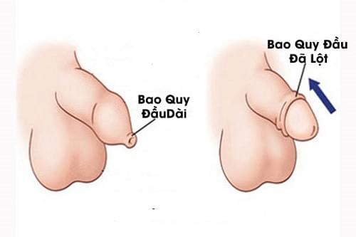 Hình ảnh trước khi cắt bao quy đầu Hình ảnh trước khi cắt bao quy đầu