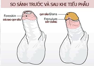 Hình ảnh sau khi cắt bao quy đầu Hình ảnh sau khi cắt bao quy đầu