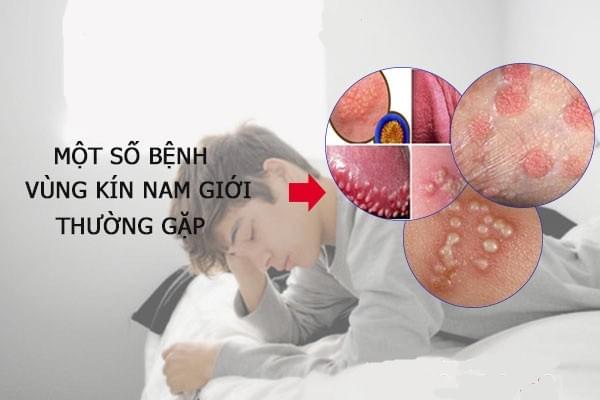 Bệnh ngoài da ở vùng kín nam giới thường gặp là gì Bệnh ngoài da ở vùng kín nam giới thường gặp là gì