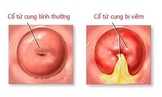 Hình ảnh bệnh vùng kín ở nữ giới như thế nào Hình ảnh bệnh vùng kín ở nữ giới như thế nào
