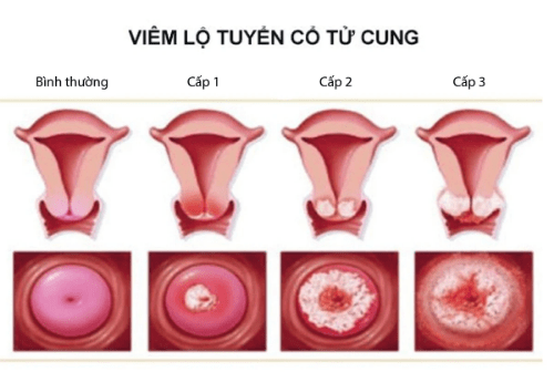 Bệnh phụ khoa ngứa vùng kín là bị gì Bệnh phụ khoa ngứa vùng kín là bị gì
