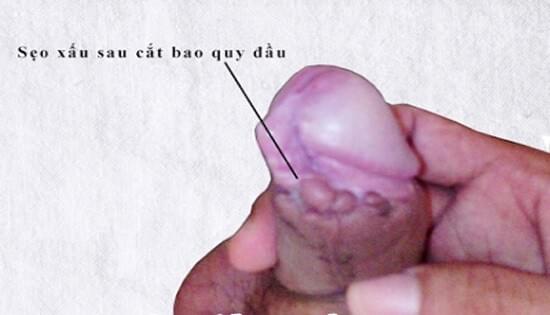 Cắt bao quy đầu bị sẹo tại cơ sở y tế kém chất lượng Cắt bao quy đầu bị sẹo tại cơ sở y tế kém chất lượng
