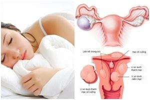 Dấu hiệu viêm nhiễm vùng kín ở nữ Dấu hiệu viêm nhiễm vùng kín ở nữ