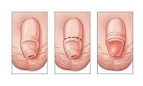 Hình ảnh sau khi cắt bao quy đầu Hình ảnh sau khi cắt bao quy đầu