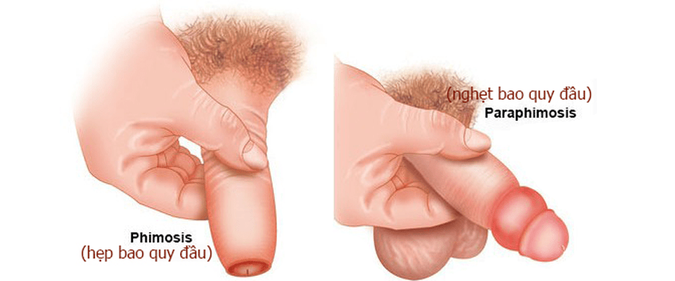 Hình ảnh trước khi cắt bao quy đầu Hình ảnh trước khi cắt bao quy đầu