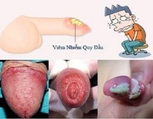 Bệnh ngoài da ở vùng kín nam giới thường gặp là gì Bệnh ngoài da ở vùng kín nam giới thường gặp là gì