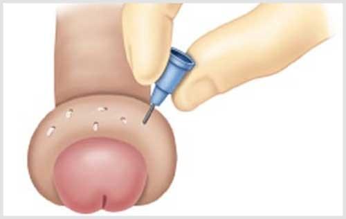 Bao quy đầu bị sưng mọng nước là bị gì Bao quy đầu bị sưng mọng nước là bị gì