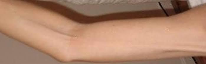 axillary web syndrome axillary web syndrome