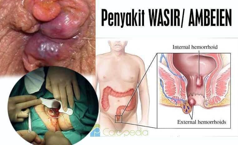 10 Perubatan Mudah Untuk Mengurangkan Buasir Ubat Buasir