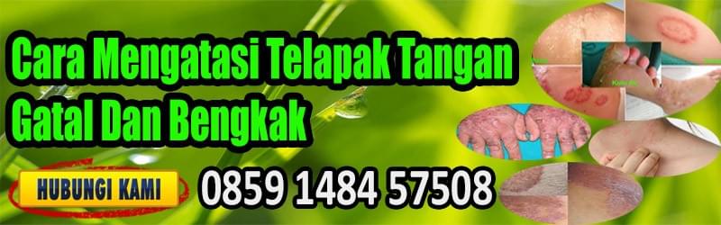 Cara Menghilangkan Bintik Berair Di Tangan - Salam Sehat