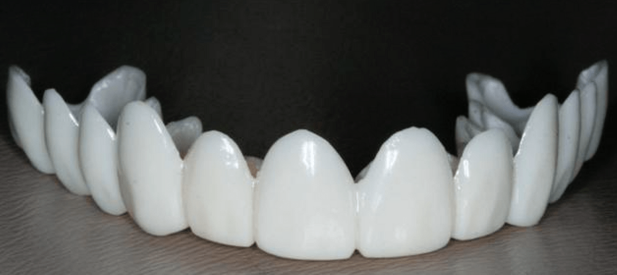 Clip on Veneers on Strikingly