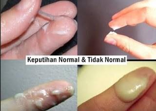 Cara Menghilangkan Keputihan Bau Dengan Obat Herbal Resep Dokter Obat Keputihan Bau