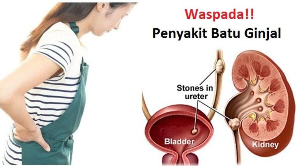 Jual Obat Kencing Batu Ginjal Di Apotik Kimia Farma Jual Obat Kencing Batu Ginjal Di Apotik Kimia Farma
