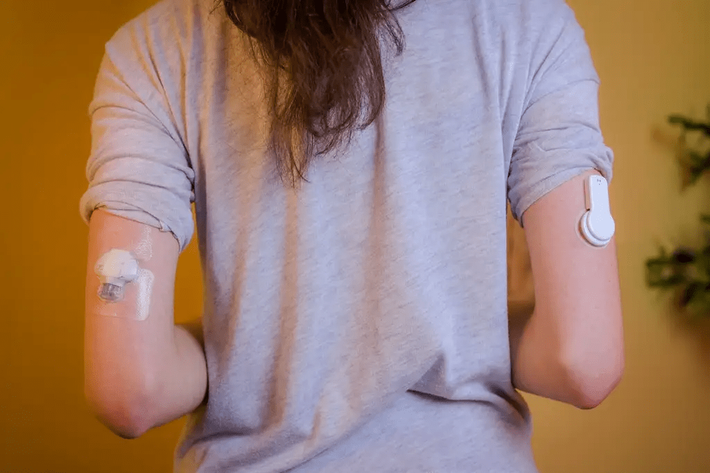 Lijevo nosim Medtronic Guardian Connect, desno Freestyle Libre s Miaomiao2 odašiljačem Lijevo nosim Medtronic Guardian Connect, desno Freestyle Libre s Miaomiao2 odašiljačem