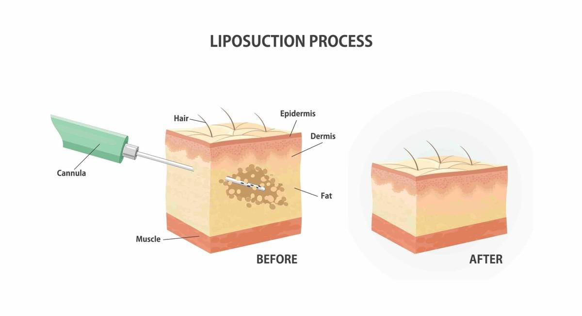 San Antonio liposuction San Antonio liposuction