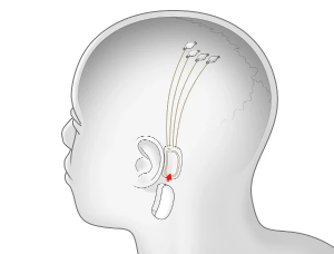 Երբևէ լսե՞լ եք «Նեյրոլինկի» (Neuralink) մասին։ Ամերիկացի ճարտարագետ ու գյուտարար Իլոն Մասկն իր հարցազրույցներից մեկում պատմում է «Նեյրոլինկի» մասին, որոնք ճշմարիտ լինելու դեպքում կարող են արմատապես փոխել մարդկանց կյանքը Երկրի վրա և դրա սահմաններից դուրս։ Մասկի ընկերությունը ծրագրավորում է մի սարք, որը հնարավոր կլինի վիրահատության միջոցով միացնել ուղեղի նյարդերին և համագործակցության մեջ դնել մարդու ուղեղի հետ։ Ըստ Մասկի, այն 2․5սմ տրամագծով շրջանաձև սարքավորում է, որն աշխատում է նյարդային համակարգի սկզբունքով և այդ պատճառով կարող է սիմբիոզի՝ այսինքն օգտակար փոխհամագործակցության մեջ դրվել մարդու գլխուղեղի հետ։ Սակայն, ի տարբերություն ուղեղի, «Նեյրոլինկը» հազար անգամ ավելի «խելացի է», այն կարող է վայրկենական լուծել բազմաթիվ դժվար խնդիրներ, որոնք մարդուց կարող էին ամիսներ պահանջել։ «Նեյրոլինկը» գերհզոր համակարգիչ է, որը տեղադրված կլինի անմիջապես մեր ուղեղում։ «Մենք վաղուց արդեն սիմբիոզի հետ ենք արհեստական ինտելեկտի հետ։ Մեր կյանքն - անհնար է պատկերացնել առանց հեռախոսների, համակարգիչների։ Սակայն մի մեծ խնդիր կա ՝ մեր համագործակցությունը տեխնոլոգիաների հետ շատ դանդաղ է, քանի որ դա անում ենք մատների միջոցով։ Նեյրոլինկի առավելությունն այն է, որ այն արագացնում է արհեստական ինտելեկտի ու մարդու փոխհամագործակցությունը միլիոնավոր անգամներ», - նշում է Մասկը։ Իսկ ի՞նչ կկարողանանք անել մենք «Նեյրոլինկի» հետ և ինչպե՞ս կփոխվի մարդկանց կյանքը։ Իլոնի խոսքով՝ պատրաստվում են գործարկել «Նեյրոլինկն» արդեն 2021-ին։ Առաջին մոդելը կկարողանա լուծել մարդկանց տեսողության, լսողության, հիշողության և բոլոր այն խնդիրներն ու հիվանդությունները, որոնք կապված են ուղեղի ու նյարդային համակարգի խանգարման հետ։ Այսինքն, օրինակ ուղեղի արատով ծնված ու ամբողջ կյանքում կույր եղած մարդը նեյրոլինկի օգնությամբ կկարողանա տեսնել։ Սակայն «Նեյրոլինկը» գնալով կզարգանա ու արդեն հաջորդ մոդելները անհավանական հնարավորություններ կտան մարդուն։ Մեր գլխում կլինի հզոր համակարգիչ և մենք վայրկյանների ընթացքում կկատարենք դժվար հաշվարկներ ու կլուծենք մեծ բարդություն ներկայացնող խնդիրներ։ Պատկերացնու՞մ եք, թե ինչ արագ կսկսեն զարգանալ տնտեսության բոլոր ոլորտները, գիտնականները ամեն օր նոր բացահայտումներ կանեն, այլ գիտնականներ օրերի ընթացքում կգտնեն դրանց կիրառությունը մեր կյանքում։ Իլոնի ասելով ՝ 5-10 տարի անց մարդիկ կկարողանան հաղորդակցվել առանց խոսքերի։ Նա իր հարցազրույցի ժամանակ բացատրեց, որ խոսելու ընթացքում մարդու ուղեղը դժվար աշխատանք է կատարում մտքերը բառերի վերածելիս և մտքի մեծ մասը կորում է այդ ճանապարհին։ Բացի այդ դիմացինը մեր խոսքերը հասկանալու համար դրանք վերլուծում է իր ձևով և ստացվում է, որ այն ինչ ուզում էինք ասել, մասնակի է հասնում դիմացինին։ Իսկ «Նեյրոլինկի» օգնությամբ մարդիկ կկարողանան փոխանակվել մտքերով և այլևս չի առաջանա իրար չհասկանալու խնդիր՝ ամեն ինչ պարզ ու հասկանալի կլինի։ Մենք մեր միտքը կկարողանանք «Նեյրոլինկի» օգնությամբ փոխանցել հենց այն տեսքով, ինչպես այն առաջացել է մեր գլխում ՝ առանց բառեր օգտագործելու անհրաժեշտության։ Մյուս հետաքրքիր առավելությունը, որ «Նեյրոլինկը» կարող է տալ՝ հիշողությունների ամբողջական պահպանումն է։ Մենք ցանկացած պահի կկարողանանք բացել այդ հիշողությունները, որոնք պահված կլինեն «Նեյրոլինկի» մի թաքնված անկյունում և կկարողանանք կրկին ապրել դրանք ճիշտ նույնությամբ։ Բացի այդ կկարողանանք փոփոխել մեր հիշողությունները՝ ինչպես փոփոխում ենք մեր հեռախոսի տեսանյութերը։ Սրա արդյունքում մարդկանց կյանքը կտրուկ կփոխվի։ Կկարողանանք առավոտյան արթնանալ ու «շարունակել խաղը» այն հոգեվիճակում, որում ցանկանում ենք լինել։ Բացի այդ, Իլոն Մասկը հույս ունի վերջապես լուծել աշխարհաստեղծման գաղտնիքը «Նեյրոլինկի» օգնությամբ։ Հնարավոր չէ պատկերացնել՝ ինչպիսին կլինի աշխարհին, օրինակ, 50 տարի անց, եթե «Նեյրոլինկը» հաջողությամբ գործարկվի։ Չնայած «Նեյրոլինկն» ուղղակի անհավանական հնարավորություններ կտա մարդկությանը ու նոր հորիզոններ կբացի նրա համար, սակայն այն որոշ անհանգստությունների ու վախերի առիթ էլ է տալիս և կարող է նաև վատ հետևանքներ ունենալ։ Մարդիկ այդպես հեշտ չեն ընդունի իրենց գլխում ինչ-որ օտար սարք տեղադրելու գաղափարը, քանի որ շատերը կարծում են, որ դրանք «չիպեր են» աշխարհում տոտալիտար-բռնատիրական կարգեր հաստատելու համար։ Եվ, իրոք, դրանք կարող են կառավարվել ստեղծողների կողմից և ստիպել մարդկանց անել բաներ, որոնք ստեղծողներն են ուզում։ Բացի այդ հնարավոր կլինի ամբողջությամբ վերահսկել մարդկանց կյանքը, ավելի շատ տեղեկություններ իմանալ նրանց մասին։ Եթե նույնիսկ «Նեյրոլինկ» ընկերությունը չզբաղվի դրանով, մարդիկ կարող են ինտերնետ հանցագործների զոհը դառնալ։ Վախեցնում է նաև արհեստական ինտելեկտի չափազանց զարգացումը, երբ այն սկսի ինքն իրեն սովորել ու ավելի խելացի դառնալ մարդկանցից։ Թեև Իլոնը հավատացնում է, որ այն միշտ կհամագործակցի մարդկության հետ, սակայն երաշխիքներն այդքան էլ համոզիչ չեն թվում։ Այնուամենայնիվ, եթե նույնիսկ «Նեյրոլինկը» բարեհաջող գործարկվի ու վերը նշված վատ սցենարներից ոչ մեկը չիրականանա, մեկ մեծ խնդիր դեռևս մնում է՝ արդյո՞ք մարդիկ պատրաստ են այն փոփոխություններին, որոնց բերելու է «Նեյրոլինկը»։ Արդյո՞ք մենք պատրաստ ենք հրաժարվել բանավոր խոսքից և շփվել մտովի։ Արդյո՞ք պատրաստ ենք, որ մեր մեջ լինի մի խելացի սարք, որից կախված կլինի մեր սոցիալական բարօրրությունը, քանի որ «Նեյրոլինկով» մարդիկ ապագայում մեծ առավելություն կունենան այն չունեցողների հանդեպ։ Արդյո՞ք մենք պատրաստ ենք մեր բնական կյանքից այդքան հեռանալ՝ դառնալով քայլող ռոբոտներ, որից հետո վերադարձի հույս գրեթե չի լինի։ Կարծում եմ՝ շատ դժվար կտրվի մարդկությանն այս փոփոխությունները, որոնց շեմին մենք արդեն կանգնած ենք։ Այսպիսով, մեզ անհավանական փոփոխություններ են սպասվում, որոնք լուրջ բեկում կմտցնեն մարդկանց կյանքում։ Գնա՞լ, թե՞ չգնալ այդ փոփոխություններին՝ յուրաքանչյուրը կարող է որոշել իր համար, սակայն կյանքի կանոնն այնպիսին է, որ ինչքան քիչ ես հարմարվում փոփոխություններին՝ այնքան ավելի շատ ես տուժում։ Երբևէ լսե՞լ եք «Նեյրոլինկի» (Neuralink) մասին։ Ամերիկացի ճարտարագետ ու գյուտարար Իլոն Մասկն իր հարցազրույցներից մեկում պատմում է «Նեյրոլինկի» մասին, որոնք ճշմարիտ լինելու դեպքում կարող են արմատապես փոխել մարդկանց կյանքը Երկրի վրա և դրա սահմաններից դուրս։ Մասկի ընկերությունը ծրագրավորում է մի սարք, որը հնարավոր կլինի վիրահատության միջոցով միացնել ուղեղի նյարդերին և համագործակցության մեջ դնել մարդու ուղեղի հետ։ Ըստ Մասկի, այն 2․5սմ տրամագծով շրջանաձև սարքավորում է, որն աշխատում է նյարդային համակարգի սկզբունքով և այդ պատճառով կարող է սիմբիոզի՝ այսինքն օգտակար փոխհամագործակցության մեջ դրվել մարդու գլխուղեղի հետ։ Սակայն, ի տարբերություն ուղեղի, «Նեյրոլինկը» հազար անգամ ավելի «խելացի է», այն կարող է վայրկենական լուծել բազմաթիվ դժվար խնդիրներ, որոնք մարդուց կարող էին ամիսներ պահանջել։ «Նեյրոլինկը» գերհզոր համակարգիչ է, որը տեղադրված կլինի անմիջապես մեր ուղեղում։ «Մենք վաղուց արդեն սիմբիոզի հետ ենք արհեստական ինտելեկտի հետ։ Մեր կյանքն - անհնար է պատկերացնել առանց հեռախոսների, համակարգիչների։ Սակայն մի մեծ խնդիր կա ՝ մեր համագործակցությունը տեխնոլոգիաների հետ շատ դանդաղ է, քանի որ դա անում ենք մատների միջոցով։ Նեյրոլինկի առավելությունն այն է, որ այն արագացնում է արհեստական ինտելեկտի ու մարդու փոխհամագործակցությունը միլիոնավոր անգամներ», - նշում է Մասկը։ Իսկ ի՞նչ կկարողանանք անել մենք «Նեյրոլինկի» հետ և ինչպե՞ս կփոխվի մարդկանց կյանքը։ Իլոնի խոսքով՝ պատրաստվում են գործարկել «Նեյրոլինկն» արդեն 2021-ին։ Առաջին մոդելը կկարողանա լուծել մարդկանց տեսողության, լսողության, հիշողության և բոլոր այն խնդիրներն ու հիվանդությունները, որոնք կապված են ուղեղի ու նյարդային համակարգի խանգարման հետ։ Այսինքն, օրինակ ուղեղի արատով ծնված ու ամբողջ կյանքում կույր եղած մարդը նեյրոլինկի օգնությամբ կկարողանա տեսնել։ Սակայն «Նեյրոլինկը» գնալով կզարգանա ու արդեն հաջորդ մոդելները անհավանական հնարավորություններ կտան մարդուն։ Մեր գլխում կլինի հզոր համակարգիչ և մենք վայրկյանների ընթացքում կկատարենք դժվար հաշվարկներ ու կլուծենք մեծ բարդություն ներկայացնող խնդիրներ։ Պատկերացնու՞մ եք, թե ինչ արագ կսկսեն զարգանալ տնտեսության բոլոր ոլորտները, գիտնականները ամեն օր նոր բացահայտումներ կանեն, այլ գիտնականներ օրերի ընթացքում կգտնեն դրանց կիրառությունը մեր կյանքում։ Իլոնի ասելով ՝ 5-10 տարի անց մարդիկ կկարողանան հաղորդակցվել առանց խոսքերի։ Նա իր հարցազրույցի ժամանակ բացատրեց, որ խոսելու ընթացքում մարդու ուղեղը դժվար աշխատանք է կատարում մտքերը բառերի վերածելիս և մտքի մեծ մասը կորում է այդ ճանապարհին։ Բացի այդ դիմացինը մեր խոսքերը հասկանալու համար դրանք վերլուծում է իր ձևով և ստացվում է, որ այն ինչ ուզում էինք ասել, մասնակի է հասնում դիմացինին։ Իսկ «Նեյրոլինկի» օգնությամբ մարդիկ կկարողանան փոխանակվել մտքերով և այլևս չի առաջանա իրար չհասկանալու խնդիր՝ ամեն ինչ պարզ ու հասկանալի կլինի։ Մենք մեր միտքը կկարողանանք «Նեյրոլինկի» օգնությամբ փոխանցել հենց այն տեսքով, ինչպես այն առաջացել է մեր գլխում ՝ առանց բառեր օգտագործելու անհրաժեշտության։ Մյուս հետաքրքիր առավելությունը, որ «Նեյրոլինկը» կարող է տալ՝ հիշողությունների ամբողջական պահպանումն է։ Մենք ցանկացած պահի կկարողանանք բացել այդ հիշողությունները, որոնք պահված կլինեն «Նեյրոլինկի» մի թաքնված անկյունում և կկարողանանք կրկին ապրել դրանք ճիշտ նույնությամբ։ Բացի այդ կկարողանանք փոփոխել մեր հիշողությունները՝ ինչպես փոփոխում ենք մեր հեռախոսի տեսանյութերը։ Սրա արդյունքում մարդկանց կյանքը կտրուկ կփոխվի։ Կկարողանանք առավոտյան արթնանալ ու «շարունակել խաղը» այն հոգեվիճակում, որում ցանկանում ենք լինել։ Բացի այդ, Իլոն Մասկը հույս ունի վերջապես լուծել աշխարհաստեղծման գաղտնիքը «Նեյրոլինկի» օգնությամբ։ Հնարավոր չէ պատկերացնել՝ ինչպիսին կլինի աշխարհին, օրինակ, 50 տարի անց, եթե «Նեյրոլինկը» հաջողությամբ գործարկվի։ Չնայած «Նեյրոլինկն» ուղղակի անհավանական հնարավորություններ կտա մարդկությանը ու նոր հորիզոններ կբացի նրա համար, սակայն այն որոշ անհանգստությունների ու վախերի առիթ էլ է տալիս և կարող է նաև վատ հետևանքներ ունենալ։ Մարդիկ այդպես հեշտ չեն ընդունի իրենց գլխում ինչ-որ օտար սարք տեղադրելու գաղափարը, քանի որ շատերը կարծում են, որ դրանք «չիպեր են» աշխարհում տոտալիտար-բռնատիրական կարգեր հաստատելու համար։ Եվ, իրոք, դրանք կարող են կառավարվել ստեղծողների կողմից և ստիպել մարդկանց անել բաներ, որոնք ստեղծողներն են ուզում։ Բացի այդ հնարավոր կլինի ամբողջությամբ վերահսկել մարդկանց կյանքը, ավելի շատ տեղեկություններ իմանալ նրանց մասին։ Եթե նույնիսկ «Նեյրոլինկ» ընկերությունը չզբաղվի դրանով, մարդիկ կարող են ինտերնետ հանցագործների զոհը դառնալ։ Վախեցնում է նաև արհեստական ինտելեկտի չափազանց զարգացումը, երբ այն սկսի ինքն իրեն սովորել ու ավելի խելացի դառնալ մարդկանցից։ Թեև Իլոնը հավատացնում է, որ այն միշտ կհամագործակցի մարդկության հետ, սակայն երաշխիքներն այդքան էլ համոզիչ չեն թվում։ Այնուամենայնիվ, եթե նույնիսկ «Նեյրոլինկը» բարեհաջող գործարկվի ու վերը նշված վատ սցենարներից ոչ մեկը չիրականանա, մեկ մեծ խնդիր դեռևս մնում է՝ արդյո՞ք մարդիկ պատրաստ են այն փոփոխություններին, որոնց բերելու է «Նեյրոլինկը»։ Արդյո՞ք մենք պատրաստ ենք հրաժարվել բանավոր խոսքից և շփվել մտովի։ Արդյո՞ք պատրաստ ենք, որ մեր մեջ լինի մի խելացի սարք, որից կախված կլինի մեր սոցիալական բարօրրությունը, քանի որ «Նեյրոլինկով» մարդիկ ապագայում մեծ առավելություն կունենան այն չունեցողների հանդեպ։ Արդյո՞ք մենք պատրաստ ենք մեր բնական կյանքից այդքան հեռանալ՝ դառնալով քայլող ռոբոտներ, որից հետո վերադարձի հույս գրեթե չի լինի։ Կարծում եմ՝ շատ դժվար կտրվի մարդկությանն այս փոփոխությունները, որոնց շեմին մենք արդեն կանգնած ենք։ Այսպիսով, մեզ անհավանական փոփոխություններ են սպասվում, որոնք լուրջ բեկում կմտցնեն մարդկանց կյանքում։ Գնա՞լ, թե՞ չգնալ այդ փոփոխություններին՝ յուրաքանչյուրը կարող է որոշել իր համար, սակայն կյանքի կանոնն այնպիսին է, որ ինչքան քիչ ես հարմարվում փոփոխություններին՝ այնքան ավելի շատ ես տուժում։