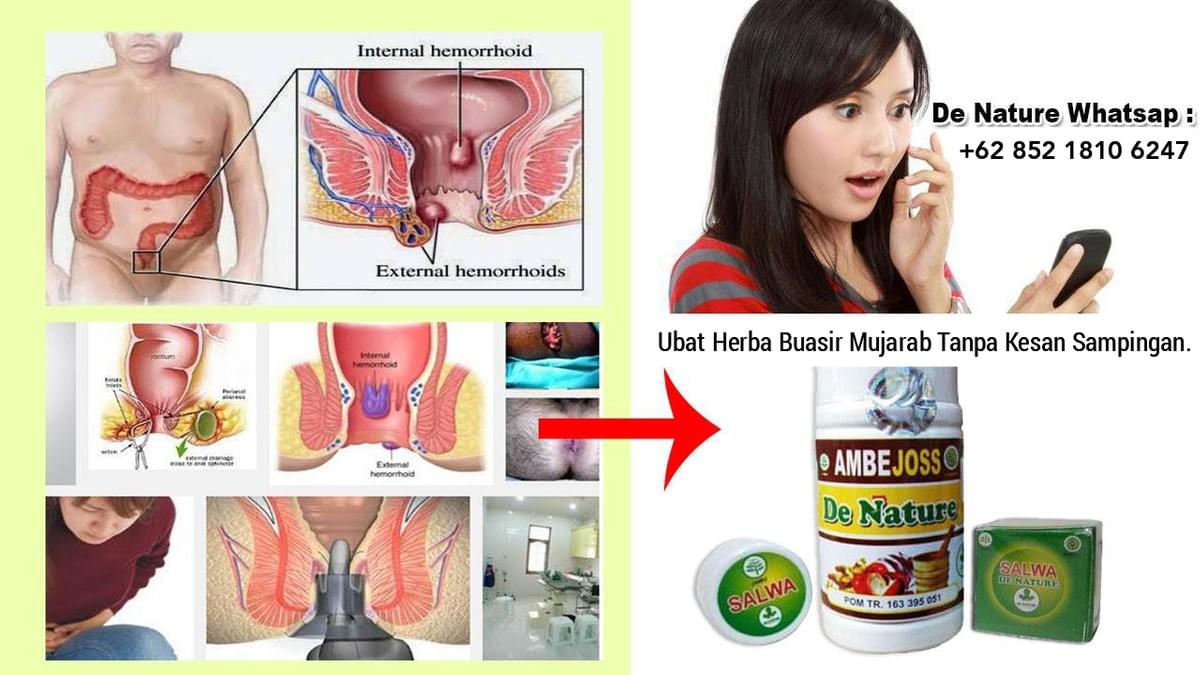 Ubat Buasir Di Singapura Paling Berkesan Ubat Buasir Berkesan Ubat Buasir Mujarab Ubat Paling Mujarab
