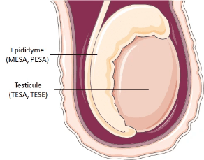 schéma de l’anatomie d’un testicule montrant l’épididyme et le testicule et localisation des techniques d'obtention des spermatozoïdes (Sperm retrieval techniques, SRT) schéma de l’anatomie d’un testicule montrant l’épididyme et le testicule et localisation des techniques d'obtention des spermatozoïdes (Sperm retrieval techniques, SRT)