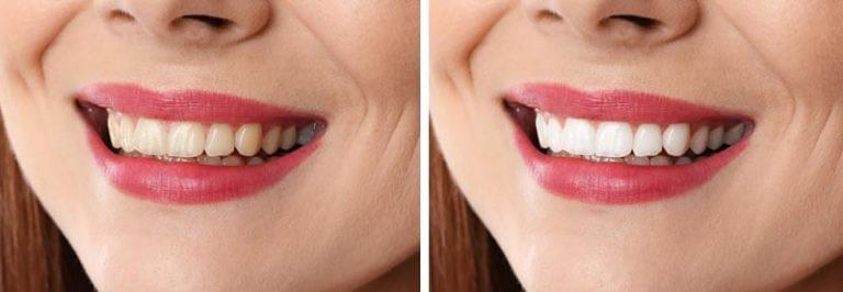 teeth whitening Moonee Ponds teeth whitening Moonee Ponds