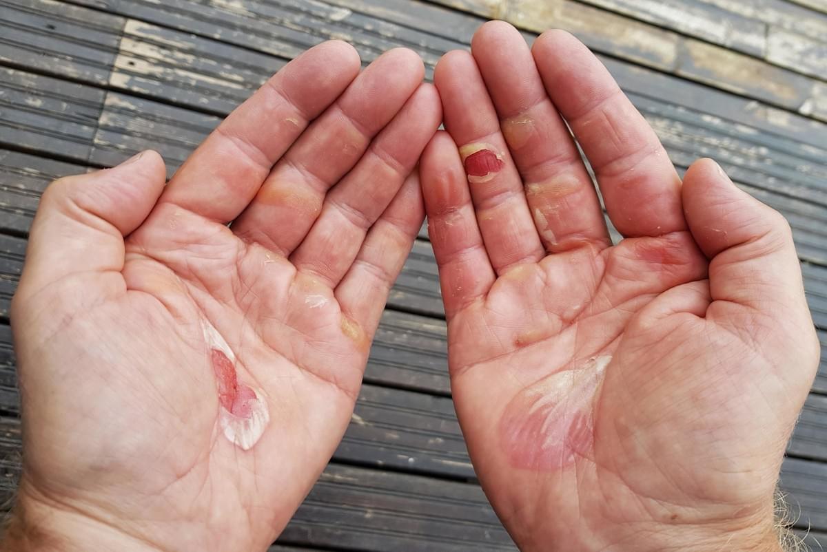 Rakkoja käsissä soutamisesta Rakkoja käsissä soutamisesta