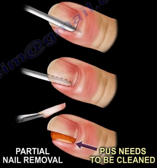 Paronychia Orthopedics Nail Infections medicine Healthcare