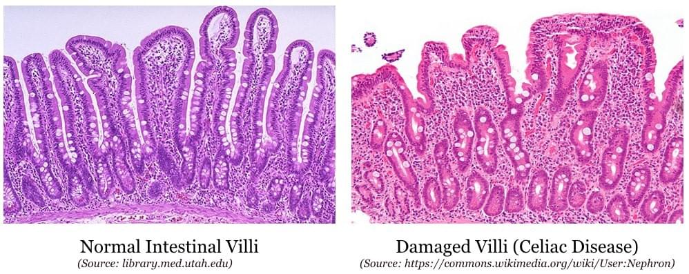 Showing a Healthy gut and a damaged gut. We require healthy villi for absorbing nutrients Showing a Healthy gut and a damaged gut. We require healthy villi for absorbing nutrients