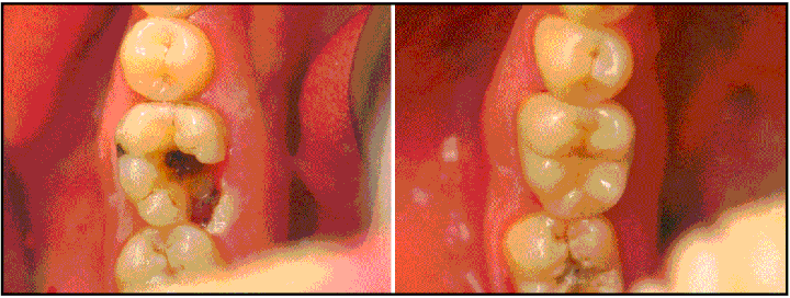 Cosmetic Dentistry - Broken Arrow Dentist I Dr. Gentling I ...