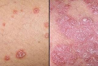 Apa Saja Penyakit Kulit Gatal - Waspadai Kulit Gatal dan Bersisik, Bisa Jadi Gejala Psoriasis! 2