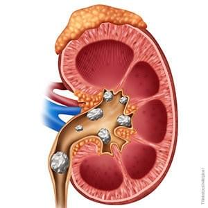 Nama Obat Batu Ginjal Paling Ampuh Di Apotik Obat Batu Ginjal