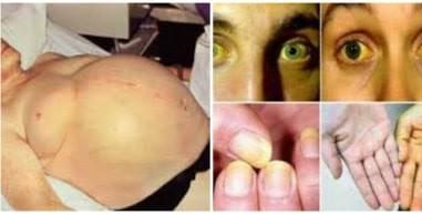Ciri Ciri Penyakit Kuning Liver Hati Akut Dan Cara Obati Dengan Obat Herbal
