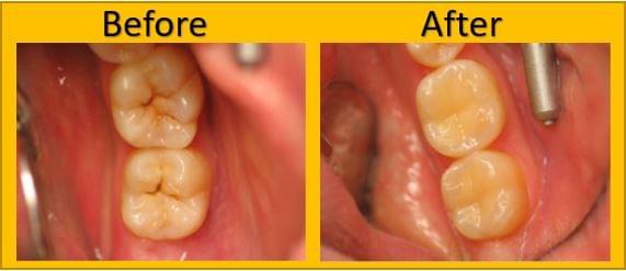 Gallery - Broken Arrow Dentist I Dr. Gentling I Family ...