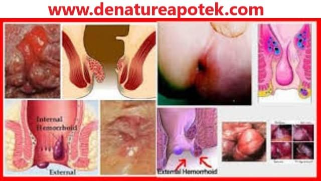 Obat Benjolan Pada Anus Alami Mujarab Di Apotik