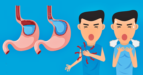 Cara Menyembuhkan Gerd Hingga Sembuh Total