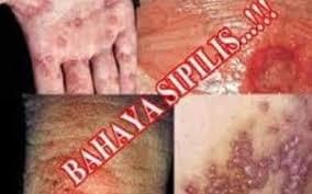 Efek Penyakit Sipilis Pada Wanita